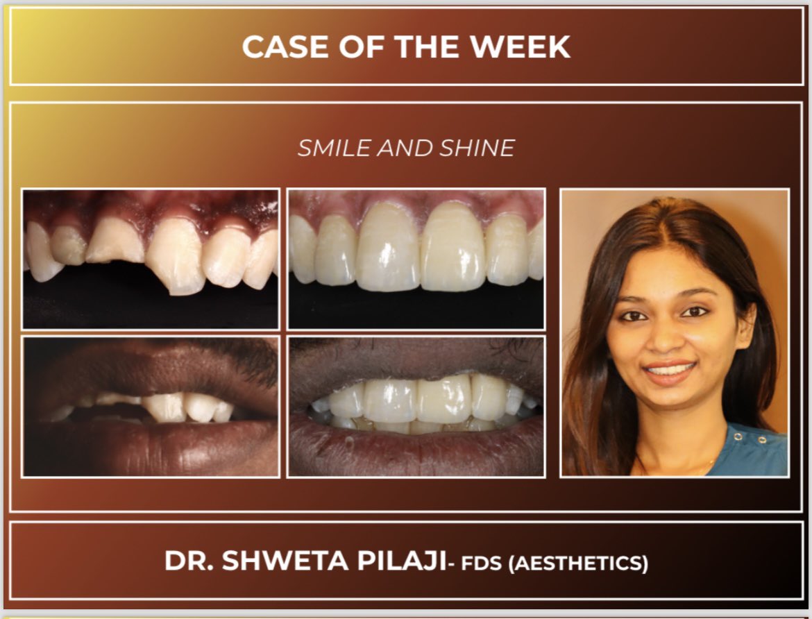 Congratulations To Dr shwetha Pilaji  from the department of aesthetics on winning the best case of the week🎉🎉

#bestcase #saveethadentalcollege #saveethaaesthetics #work #caseoftheweek #saveethauniversity #workhard