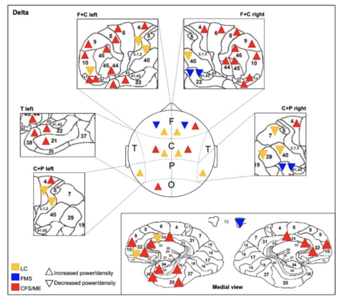 MANOJ SIVAN (@sivanmanoj) on Twitter photo EEG signatures in Long Covid, ME/CFS and Fibromyalgia - similarities and differences
Excellent work <a href="/B_SPassadouro/">Barbara Silva Passadouro</a> and others in our team <a href="/ResearchPain/">Human Pain Research Group</a> @a_casson <a href="/ByChrisb/">Christopher Brown</a> <a href="/OmarKhoja/">Omar Khoja</a>
sciencedirect.com/science/articl…
<a href="/UniversityLeeds/">University of Leeds</a>
#LongCovid <a href="/Clinicalpcs/">Clinical Post Covid Society</a> #MECFS #Fibromyalgia EEG signatures in Long Covid, ME/CFS and Fibromyalgia - similarities and differences
Excellent work <a href="/B_SPassadouro/">Barbara Silva Passadouro</a> and others in our team <a href="/ResearchPain/">Human Pain Research Group</a> @a_casson <a href="/ByChrisb/">Christopher Brown</a> <a href="/OmarKhoja/">Omar Khoja</a>
sciencedirect.com/science/articl…
<a href="/UniversityLeeds/">University of Leeds</a>
#LongCovid <a href="/Clinicalpcs/">Clinical Post Covid Society</a> #MECFS #Fibromyalgia