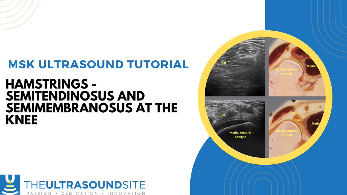 Hamstring ultrasound - highlighting the Semitendionsus and Semimembranosus at the posterior knee.

youtube.com/watch?v=2UdzwW…