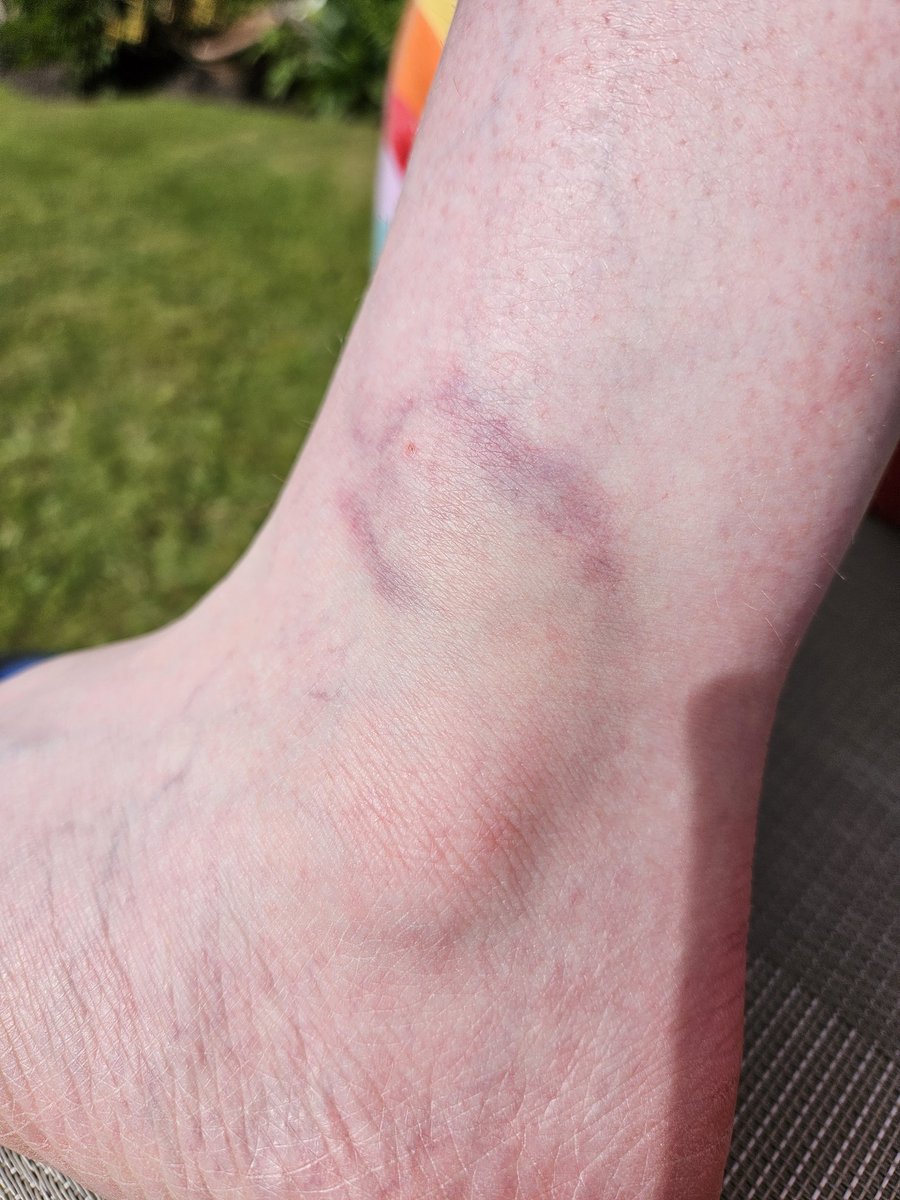 LisaMottram's tweet image. The @RNLI #MayDayMile challenge became more dangerous than my previous skydives this week. I was bitten by a dog while getting my mile in.
fundraise.rnli.org/fundraisers/li…