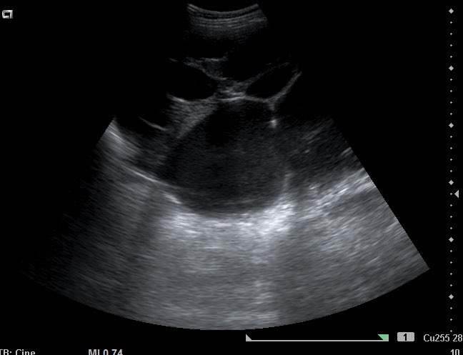 #Ecografía #atenciónprimaria 🚺 con distensión abdominal de 2 meses de evolución Imagen izda: corte pélvico. Vejiga bien replecionada. Ovario derecho de 3,8 cm con 2 imágenes quísticas en interior Resto imágenes: cortes abdomen. Masa anecoica multilobulada ▶️Cistoadenoma ovárico