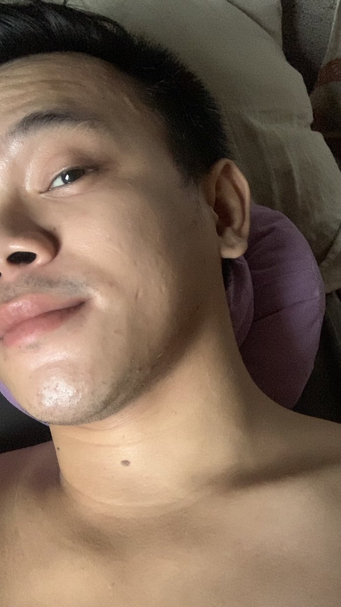 HI GUYS! 🫶🏼

thank you so much for all the answers thru DMs and for the new followers! ✨

for those DMs asking me some questions, i’ll try to answer you later. 

Just Woke Up since 10am huhu.
Im so so tired. 🥱

here’s an unnecessary face update HAHA. 

#PLHIV #PLHIVdiaries