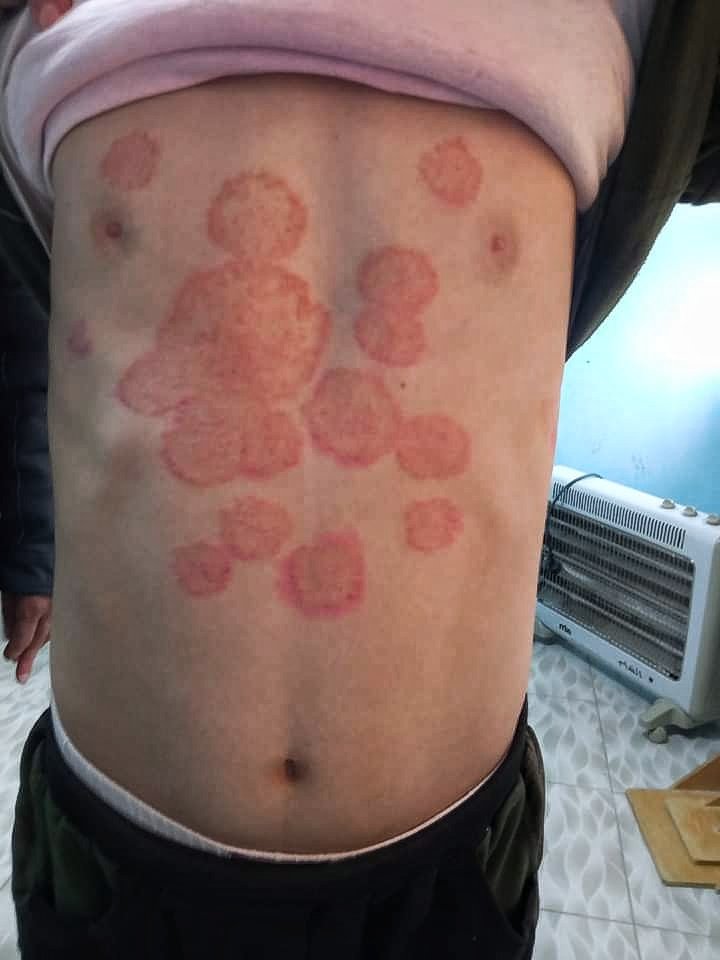 📝𝘾𝙇𝙄𝙉𝙄𝘾𝘼𝙇 𝙌𝙐𝙄𝙕:-

🍁A 10yr old child presented with  sharp edge ,#ring shaped rash over trunk & forearm.

Which #medication should be started❓

A) Terbinafine 
B) Azithromycin 
C) Metronidazole 
D) Doxycycline 

#medx
#skincare #medEd