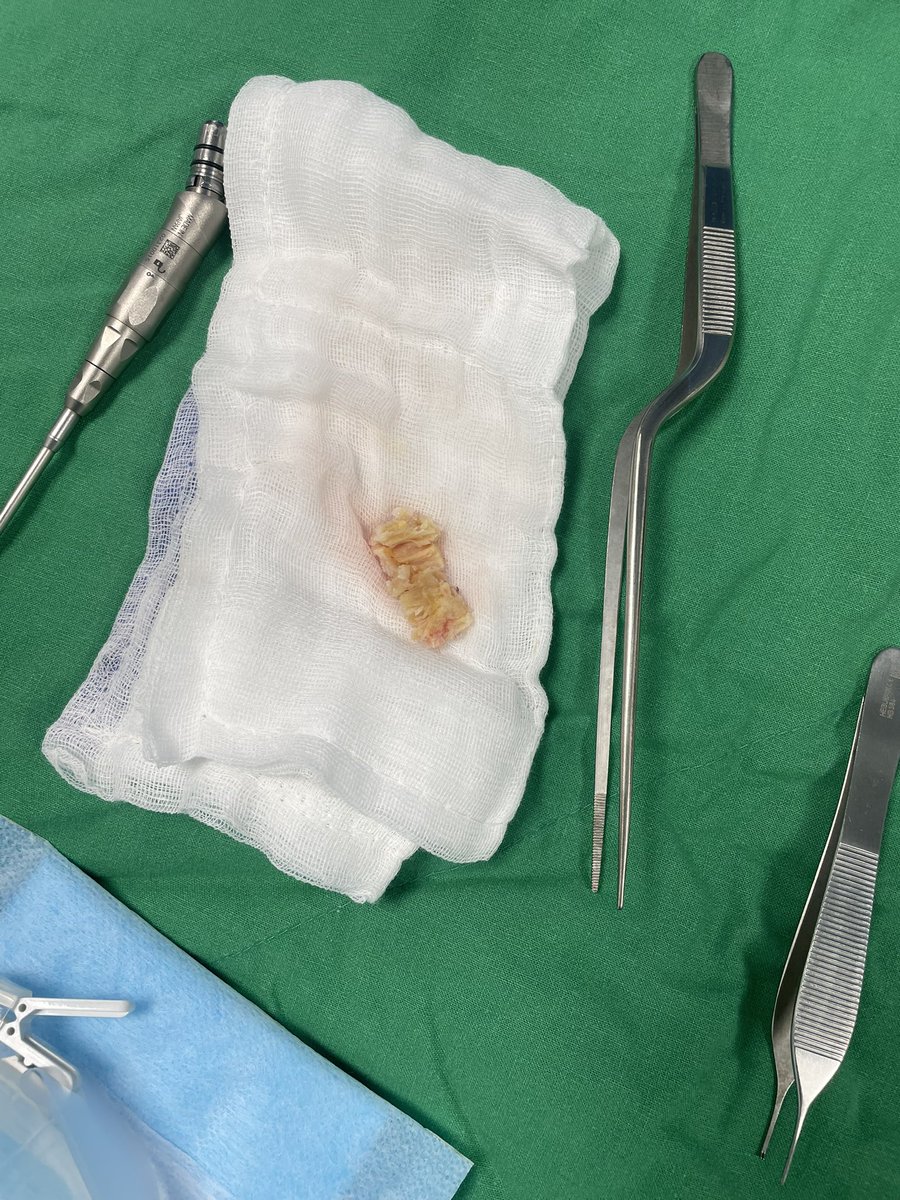 Yes, that is an en-bloc resection of the ligamental flavum through biportal endoscopic approach. Had an amazing time observing Dr. Dong Hwa Heo. He is a #maestro in #trance when performing UBE surgery. @PennNSG