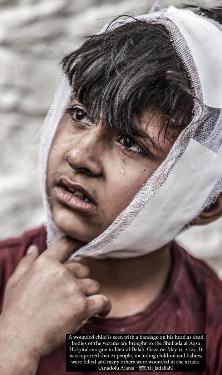 A wounded child is seen with a bandage on his head as dead bodies of the victims are brought to the Shuhada al-Aqsa Hospital morgue in Deir al-Balah, Gaza on May 11, 2024. It was reported that 21 people, including children and babies, were killed and many others were wounded in…