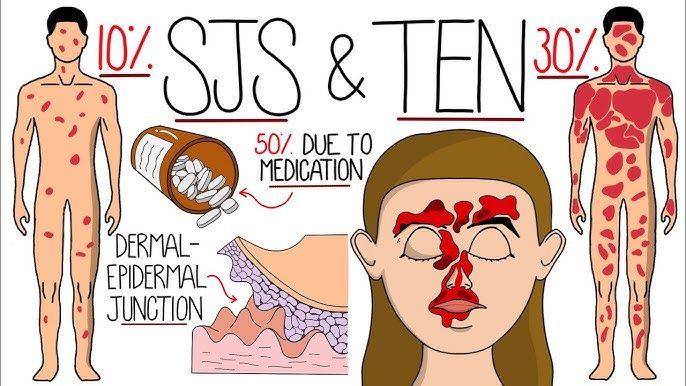 Stevens-Johnson Syndrome (SJS) and Toxic Epidermal Necrolysis (TEN) are rare but serious skin reactions that can occur as a result of certain medications. The signs and symptoms are such as fever, rash, and blistering of the skin and mucous membranes.
#SJS #TEN #Pediatrics