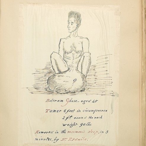 Man with a 90lb testicular tumour 'removed in the memseric sleep by Dr James Esdaile' (1808-1859) #histmed #histsurg #historyofmedicine #historyofsurgery #pastmedicalhistory