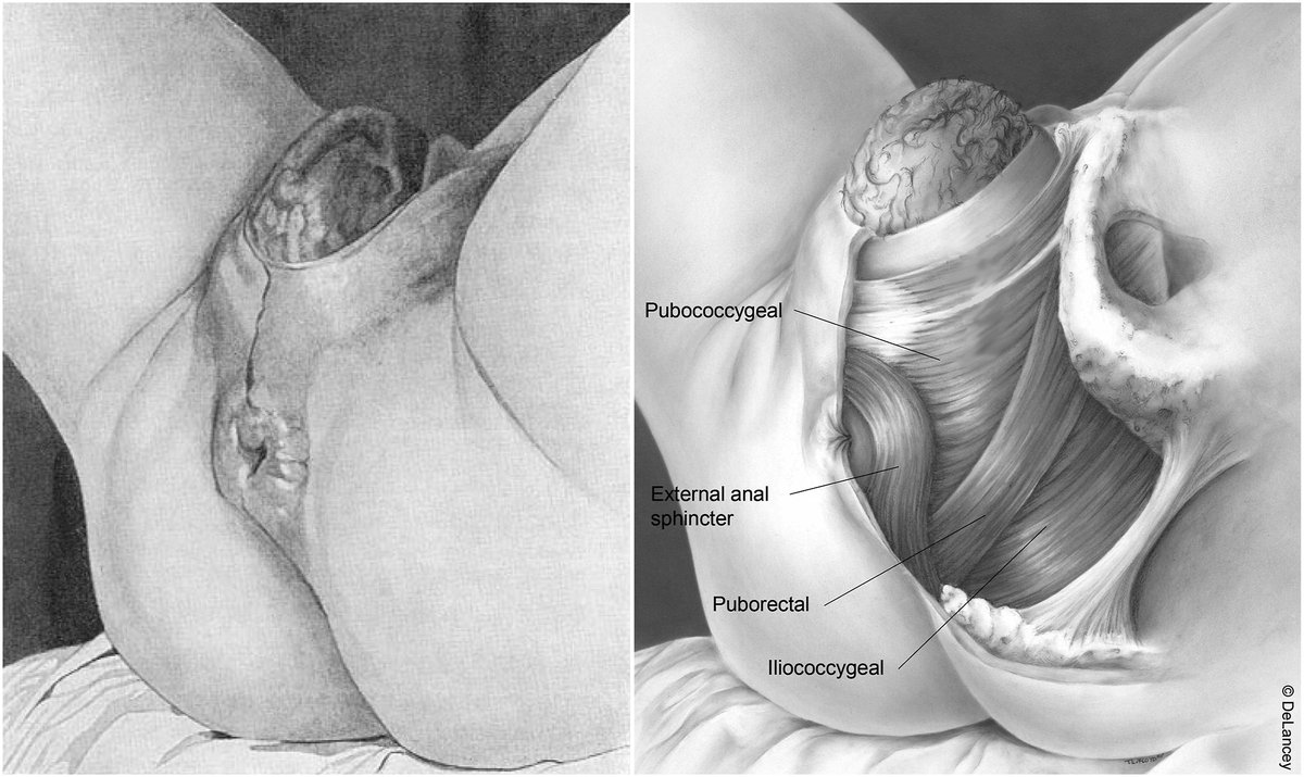 AJOG_thegray's tweet photo. AJOG Expert Review:  Pelvic floor injury during vaginal birth is life-altering and preventable: what can we do about it? - Hidden pelvic floor muscles late in the second stage of labor https://t.co/SeUxEMIG5Q https://t.co/rIGPRr7vet