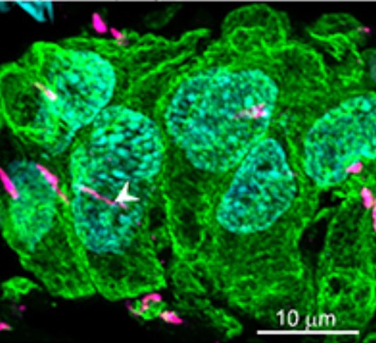 Bacteria infect the tumour of many bowel cancer patients. Our new study suggests that bacterial infections help to boost the immune system fighting off tumour cells. Great work from @RCSI_StAR_MD William Duggan & @GenomicsCRT PhD student Batuhan Kisakol. tandfonline.com/doi/full/10.10…