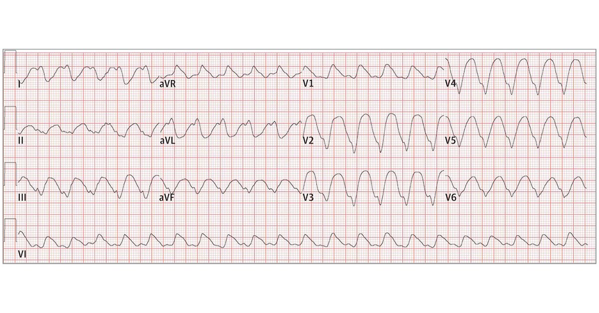 Most viewed in the last 7 days from @JAMACardio: A woman in her mid-60s presented with a history of paroxysmal atrial fibrillation and hypertension presents with 3 days of nausea, vomiting, and diarrhea. ja.ma/4aa1G12