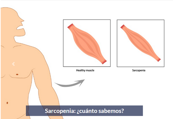 SARCOPENIA La pérdida de masa muscular es uno de los factores de riesgo más importantes de enfermedades asociadas a la edad. intramed.net/106665