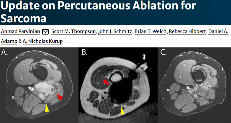 As #InterventionalOncology section editor for Current Oncology Reports, I would like to share an article that is hot off the press! Important work by Dr. Ahmad Parvinian, @ANKurupMD  & team from @MayoClinic  on the current status of percutaneous ablation in patients with…