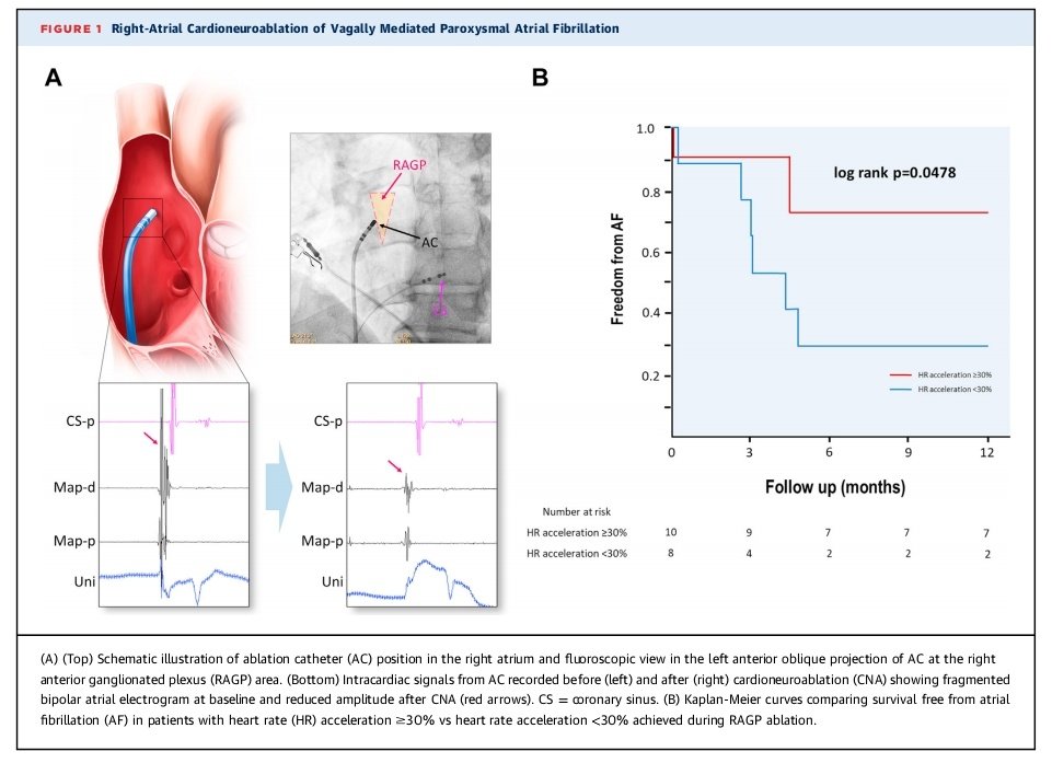 Some patients with vagally mediated AF can benefit most from cardioneuroablative effect and may not need full PVI Some of them may not even require any ablation in the left atrium Check out our @JACCJournals paper using shareable link (before it expires) authors.elsevier.com/a/1j39w,siTgkp…