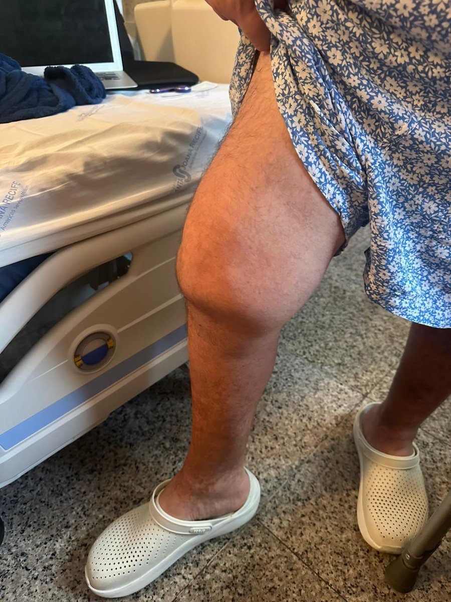 bennspinelli's tweet photo. Estou internado tem 10 dias no @santajoana_pe . Sou Hemofilico e recebo minha medicação pelo SUS! Tenho que tomá-la diariamente pra conter e/ou evitar sangramentos. Há dias que tenho problemas com o Hospital para ir buscar no Hemope, PASMÉM, do outro lado da rua + https://t.co/uw4nAldqWS