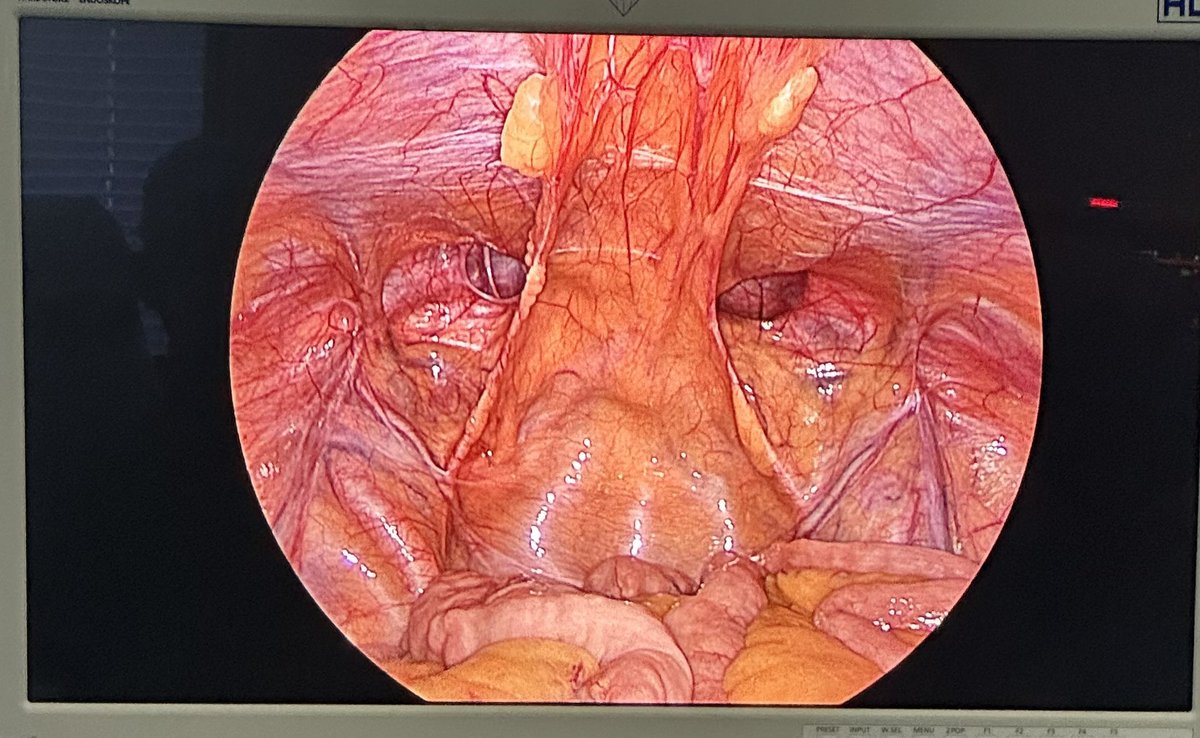 Laparoscopic view of inguinal hernia anatomy!👇
#surgery 

It is looking like??