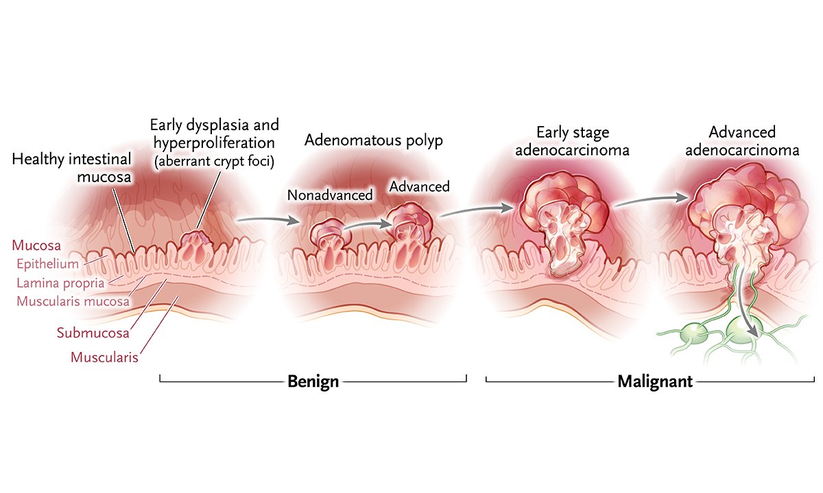 Adenomatous colon polyp: An abnormal growth of colonic mucosal cells (polyp) that is benign but that may, with time, develop into a malignant neoplasm.