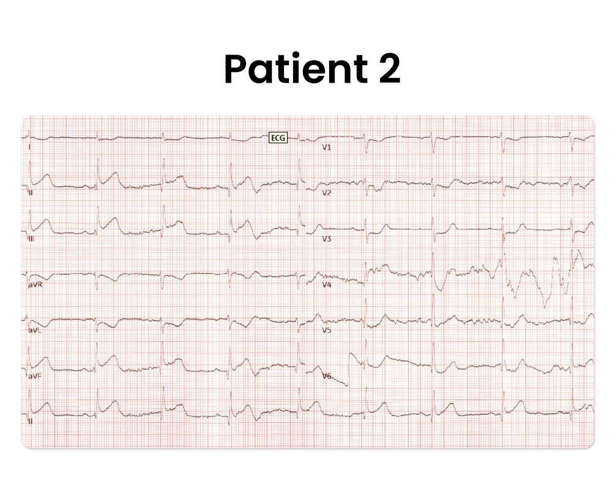 Here is the initial #ECG of two 40yo patients presenting with chest pain.