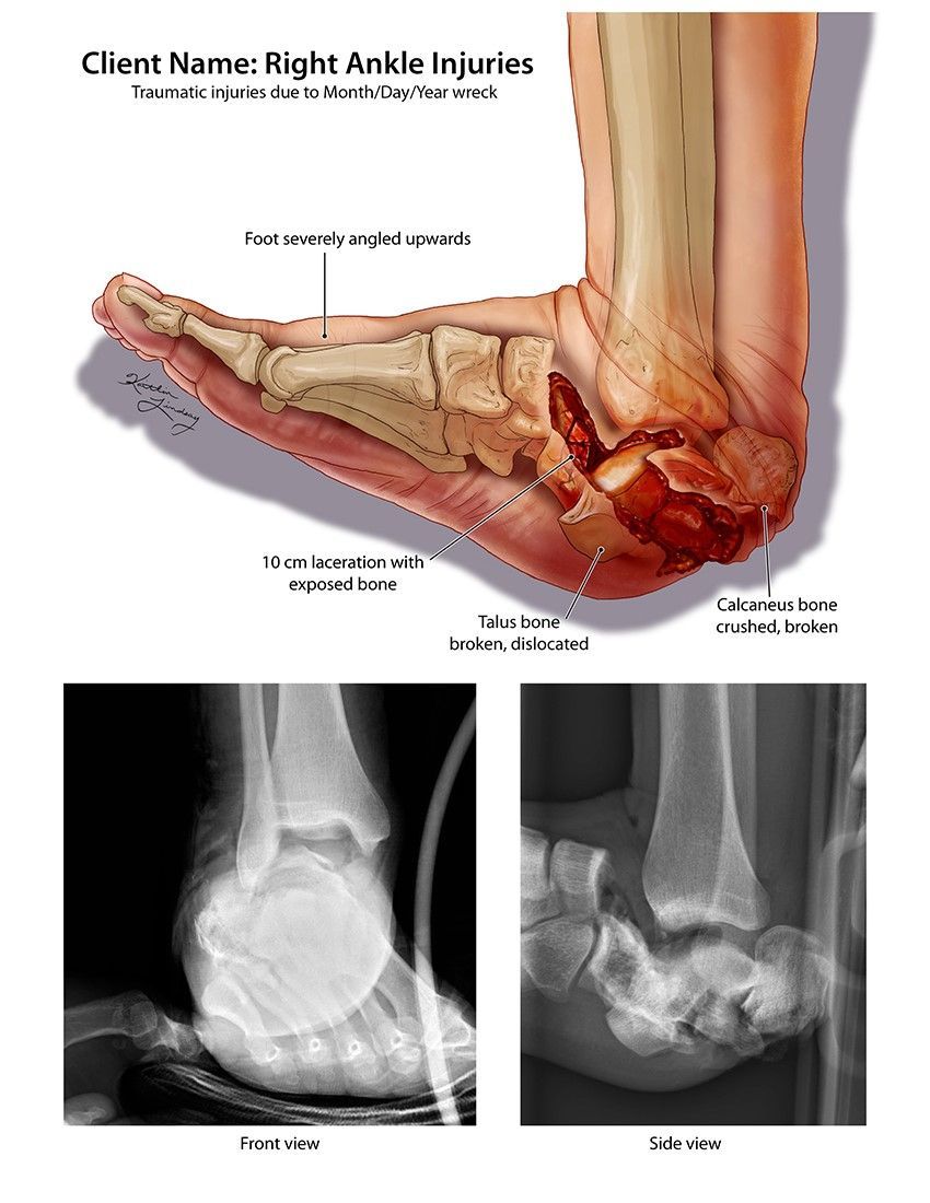 'Trial Exhibit: Traumatic Foot & Ankle Injuries,' featuring an illustration by Kaitlin Lindsay of a severe foot and ankle injury that ultimately led to amputation. Explore more: buff.ly/3qJWCgv #injury #foot #ankle #traumaticinjury #medicallegalart #medicalmalpractice