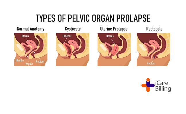 Pelvic organ prolapse is when one or more pelvic organ drop from their position. This make a bulge in the vagina, called a prolapse. The muscle & connective tissue of the pelvic floor typically hold the pelvic organs in place.
#icarebilling, best #medicalbilling solution provider