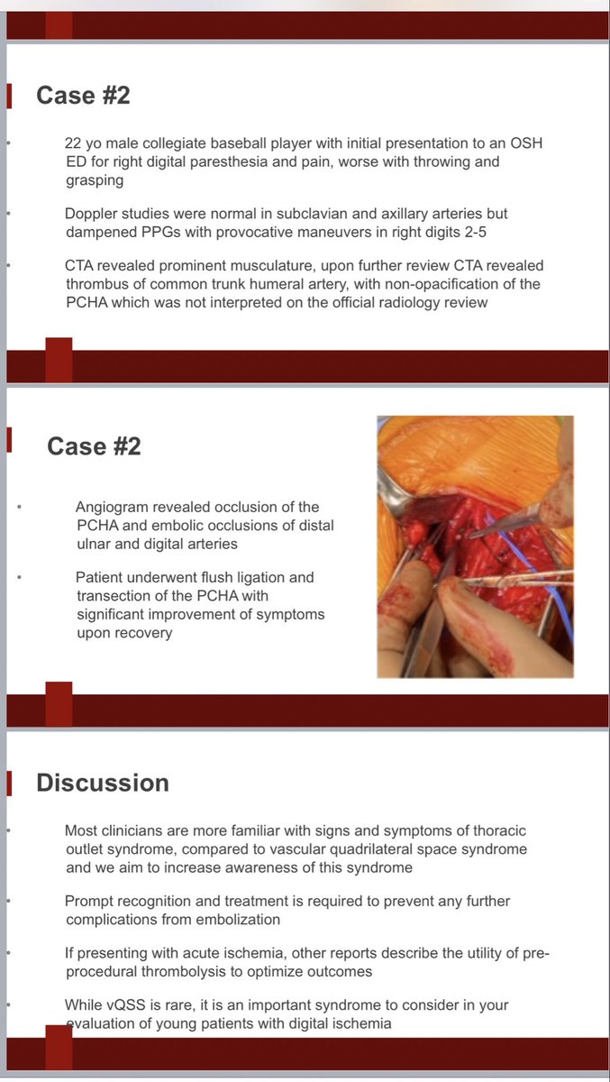 Raghu Motaganahalli (@rmotaganahalli) on Twitter photo An unusual cause for upper extremity ischemia . A diff diagnosis to case <a href="/tosinCanada/">Thoracic Outlet Syndrome TOS Awareness💥))💪🩸</a> presented by <a href="/farkomd/">frank arko</a> . Quadrilateral space syndrome treated by my partner <a href="/iu_vascular/">Division of Vascular Surgery at IUSM</a> <a href="/IU_Surgery/">Indiana Surgery -Indiana Univ School of Medicine</a> <a href="/JMaijub/">John Maijub</a> An unusual cause for upper extremity ischemia . A diff diagnosis to case <a href="/tosinCanada/">Thoracic Outlet Syndrome TOS Awareness💥))💪🩸</a> presented by <a href="/farkomd/">frank arko</a> . Quadrilateral space syndrome treated by my partner <a href="/iu_vascular/">Division of Vascular Surgery at IUSM</a> <a href="/IU_Surgery/">Indiana Surgery -Indiana Univ School of Medicine</a> <a href="/JMaijub/">John Maijub</a>
