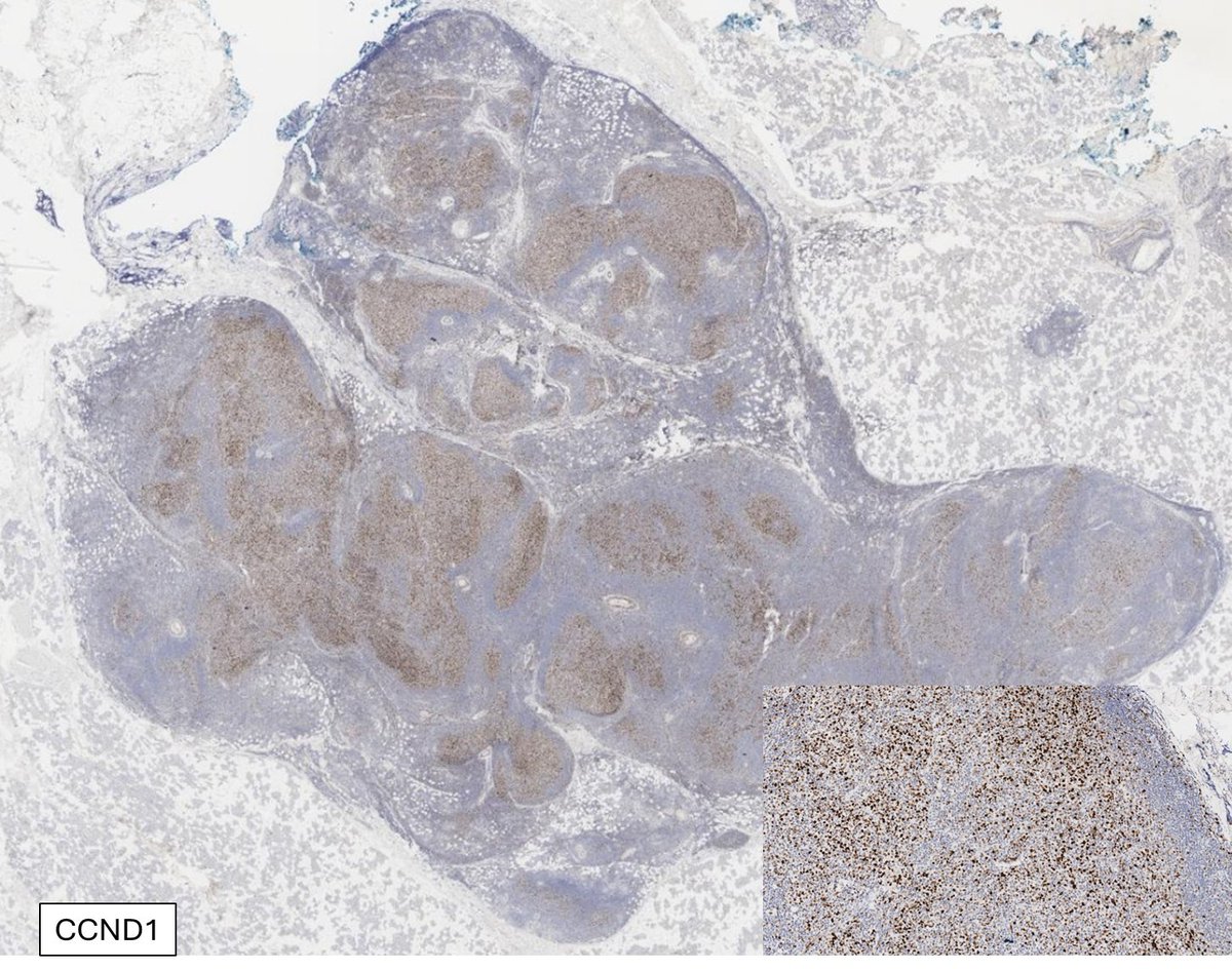 Follicular lymphoma with BCL2 rearrangement by FISH & unusual overexpression of CCND1 by IHC (CD5 & SOX11 negative; CCND1 rearrangement negative by FISH). This rare finding has been reported previously➡️shorturl.at/lzDOU but is worth to be aware of #hemepath #lymsm #PathX