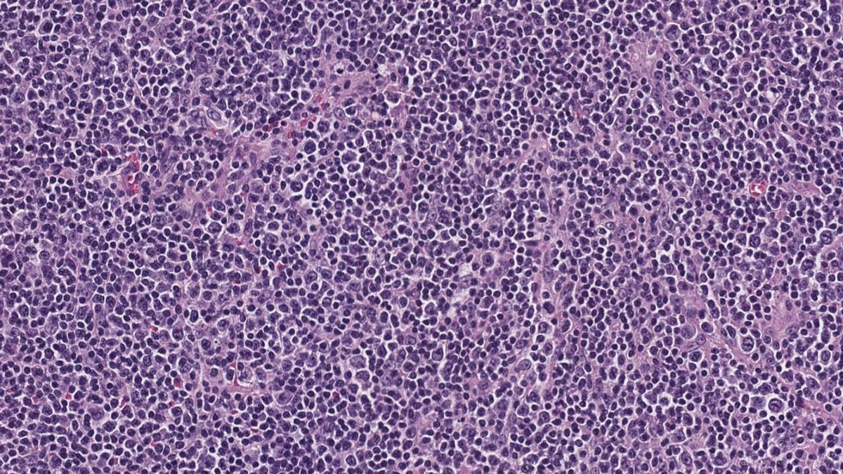 SibaElHussein's tweet image. Follicular lymphoma with BCL2 rearrangement by FISH &amp;amp; unusual overexpression of CCND1 by IHC (CD5 &amp;amp; SOX11 negative; CCND1 rearrangement negative by FISH). This rare finding has been reported previously➡️shorturl.at/lzDOU but is worth to be aware of #hemepath #lymsm #PathX