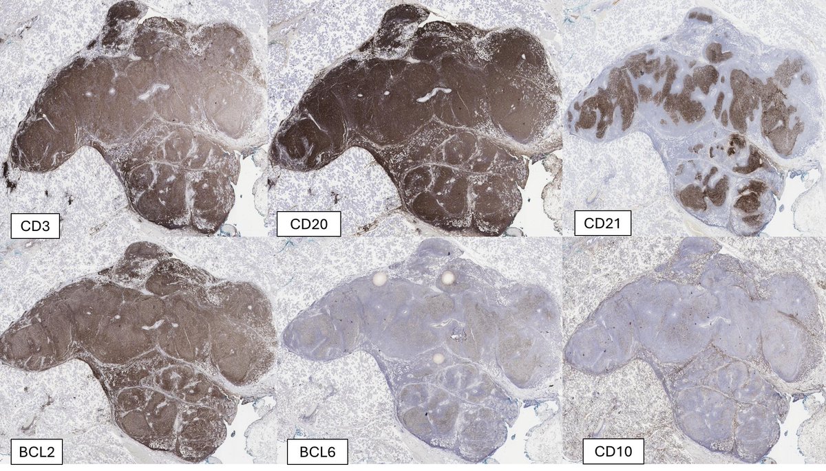 SibaElHussein's tweet image. Follicular lymphoma with BCL2 rearrangement by FISH &amp;amp; unusual overexpression of CCND1 by IHC (CD5 &amp;amp; SOX11 negative; CCND1 rearrangement negative by FISH). This rare finding has been reported previously➡️shorturl.at/lzDOU but is worth to be aware of #hemepath #lymsm #PathX