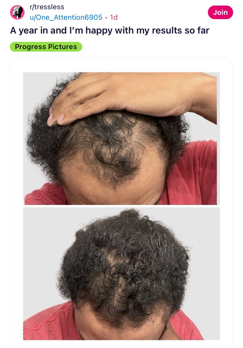 MALE PATTERN BALDNESS IS TREATABLE!!!!