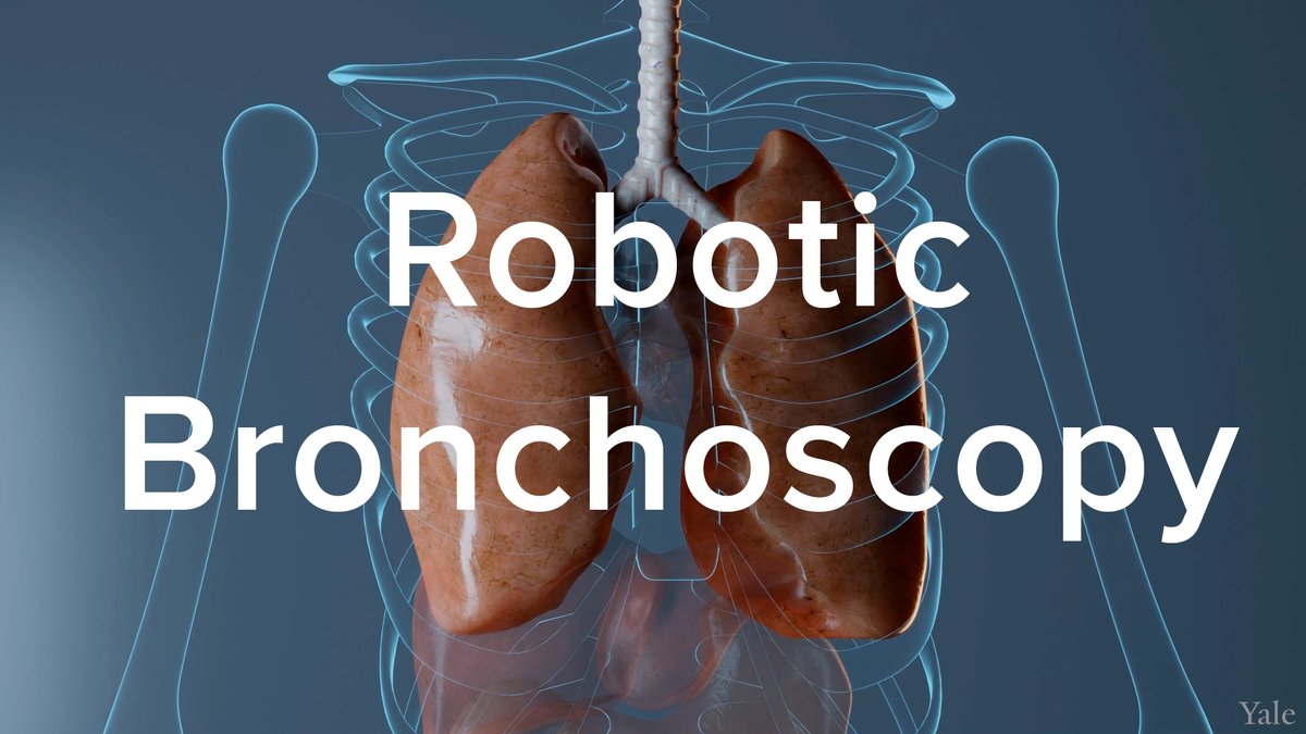 Lung Cancer and Robotic Bronchoscopy 
When caught early, lung cancer can often be successfully treated. @YaleMedicine physicians use a new form of technology called “robotic bronchoscopy,” which allows them to better reach smaller parts of the lungs. bit.ly/3JV3rnU