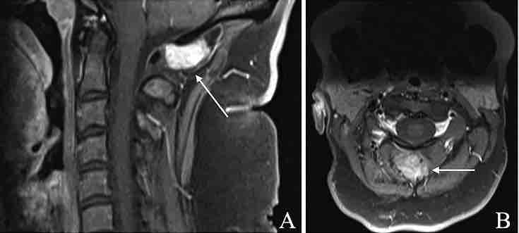 #JNSCaseLessons: An illustrative case of diffuse-type tenosynovial giant cell tumor between the suboccipital bone and posterior C1 arch thejns.org/caselessons/vi…