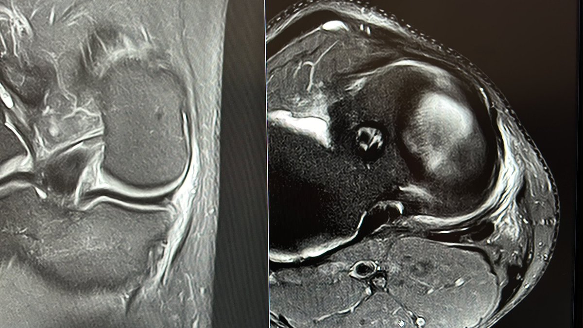 ARTRORM's tweet image. Not quite common acute injury of POL