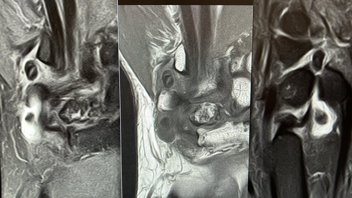 ARTRORM's tweet image. Pisotriquetral loose bodies