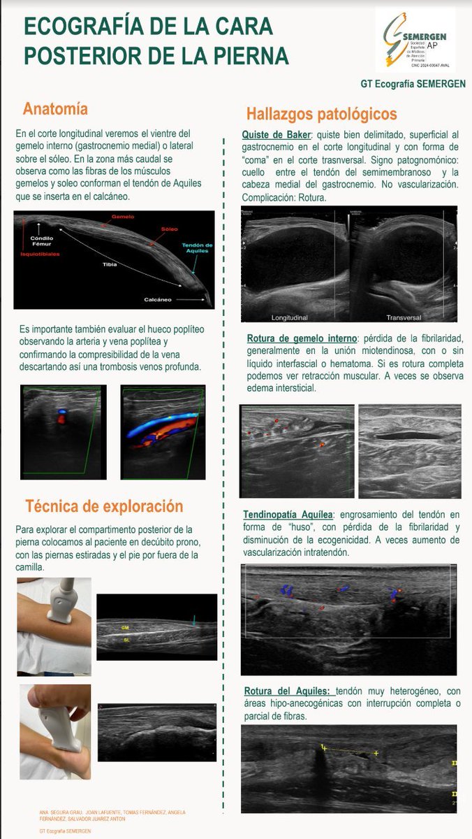 📈INFOGRAFÍA. Ecografía de la cara posterior de la pierna. Realizada por @GTEcoSemergen semergen.es/files/docs/gru… #Ecografía #pierna #MFyC @anaseguragrau