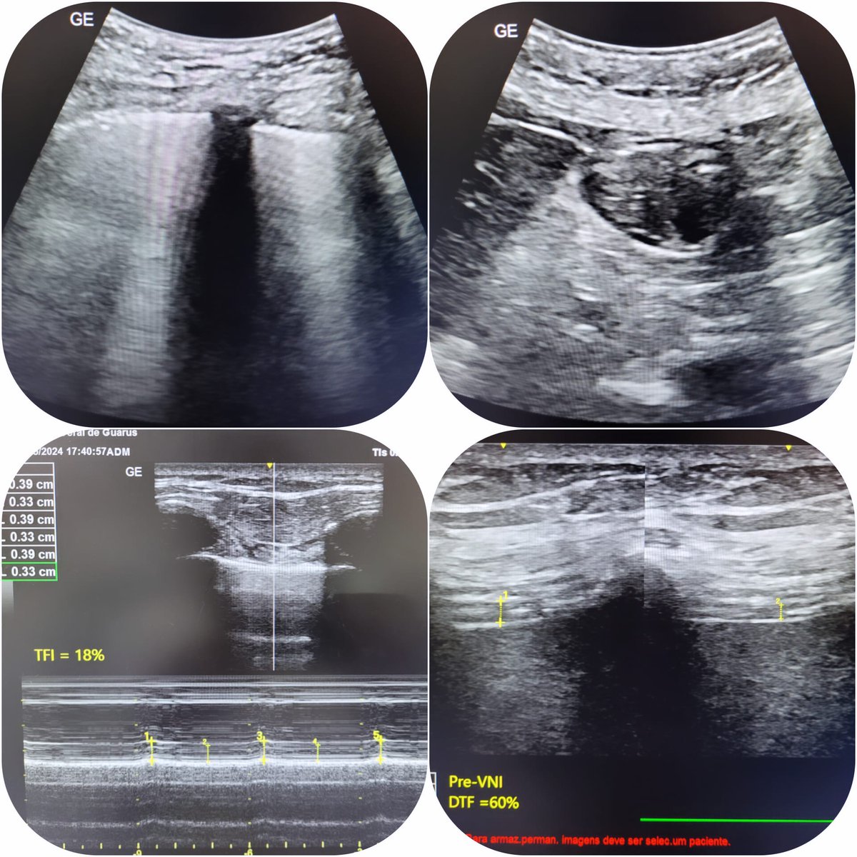 Assessments during the NIV > LUS > GASTRIC ULTRASOUND for aspiration risk > Intercostal Thickening Fraction > Diaphragm Thickening Fraction