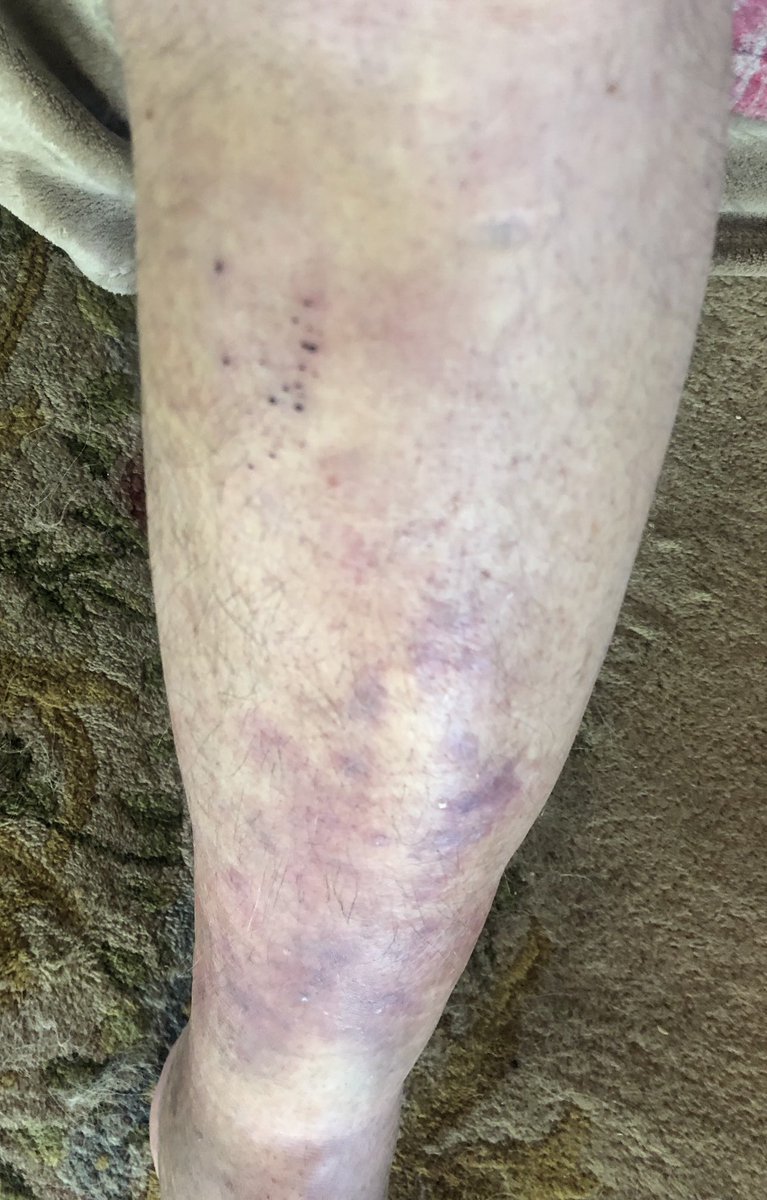 I’ve competed all my life. Injuries and competition go hand in hand. But when I dropped a 60 lb. weight on my shin last Saturday it hurt but wasn’t bad. But motherf@cker it looks like it’s getting worse and not better. F@ck it, I’m wearing shorts anyways. #accidentprone