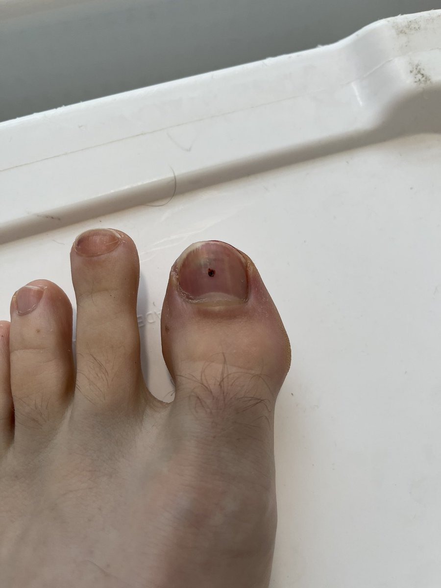 Before and after trephination of my runners toe!

Amazing how even 6 DAYS after injury there was so much pressure and fluid build up. The relief was instant.