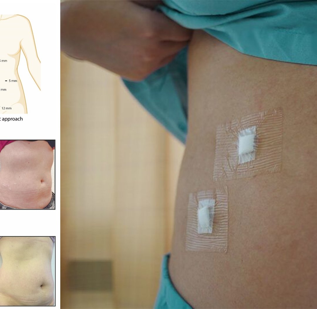 Is there any impact of the gender of the patient on the outcome of the laparoscopic and robotic Cholecystectomy

surgexpo.online/is-there-any-i…

#surgery #AbdominalSurgery #roboticsurgery #surgeryupdate #woundhealing #LaparoscopicSurgery #postopcare #postoprecovery