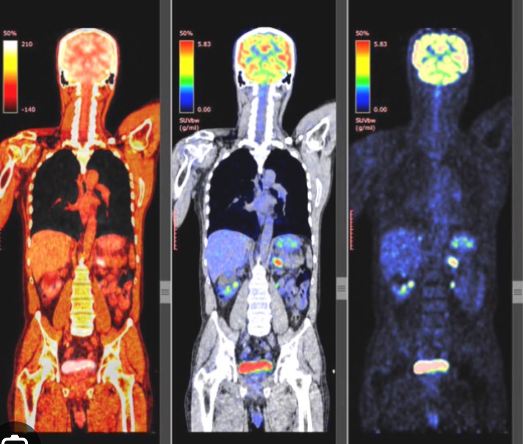 For everyone who missed out on the northern lights at least PET scans are the aurora borealis of medical imaging 🤷🏻‍♂️