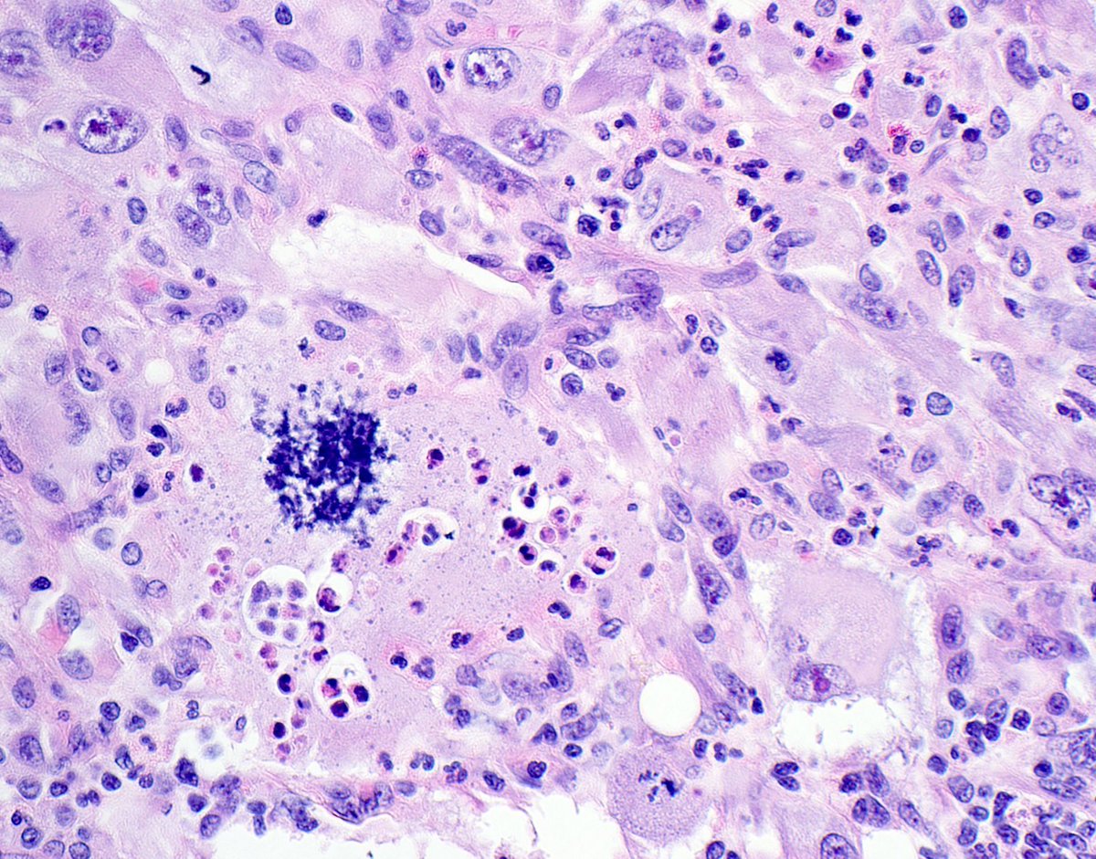 Large thigh mass in an adult. Your diagnosis? Answer & more pics here: kikoxp.com/posts/10213. Video on how I work up pleomorphic spindle cell tumors (IHC etc): kikoxp.com/posts/9839. #BSTpath #pathologists #pathology #pathTwitter #dermpath #dermatology #dermtwitter