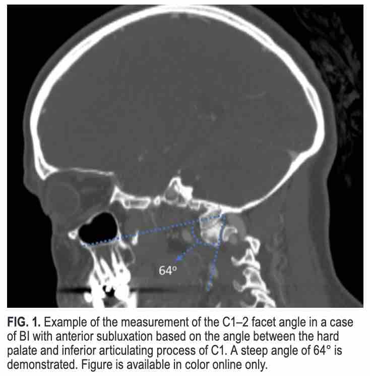 #OnlineFirst: A novel classification and management scheme for craniocervical junction disorders with ventral neural element compression. thejns.org/view/journals/….