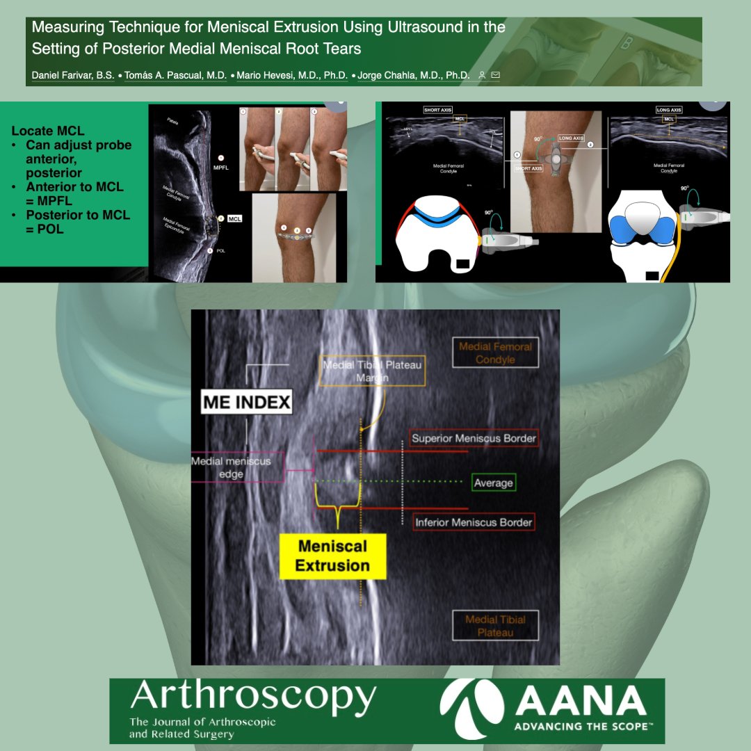 Measuring Technique for Meniscal Extrusion Using Ultrasound in the Setting of Posterior Medial Meniscal Root Tears #MeniscalRoot #UItrasound @MarioHevesiMD @jachahla ow.ly/H3mA50Rt378