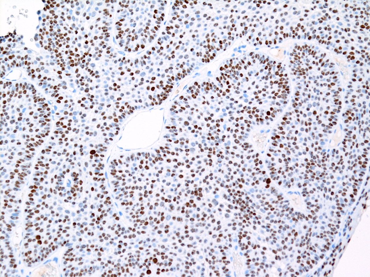 DEK::AFF2 SCC is a rare entity! *Nuclear* AFF2 IHC staining is a novel diagnostic tool for DEK::AFF2 SCC. DEK is a nuclear protein, so when AFF2 is fused to DEK, the AFF2 protein is translocated to the nucleus. #PathTwitter #ENTpath #MolPath