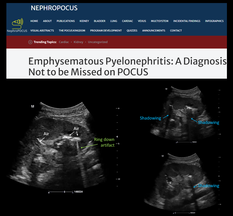 Newest post on NephroPOCUS.com 
Emphysematous pyelonephritis. Shout out to @JMMR83  for the illustrative images!
#POCUS #MedEd #FOAMed #Nephpearls