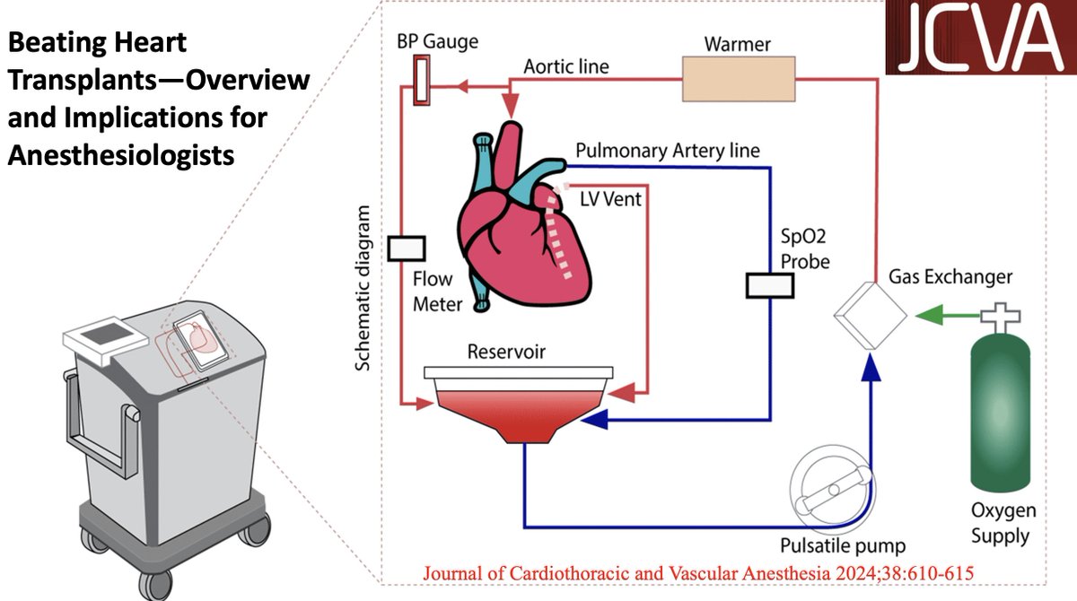 Beating #Heart #Transplants—Overview and Implications for Anesthesiologists Learn the surgical approach, advantages/disadvantages, and analogs to current clinical practice.  doi.org/10.1053/j.jvca…
