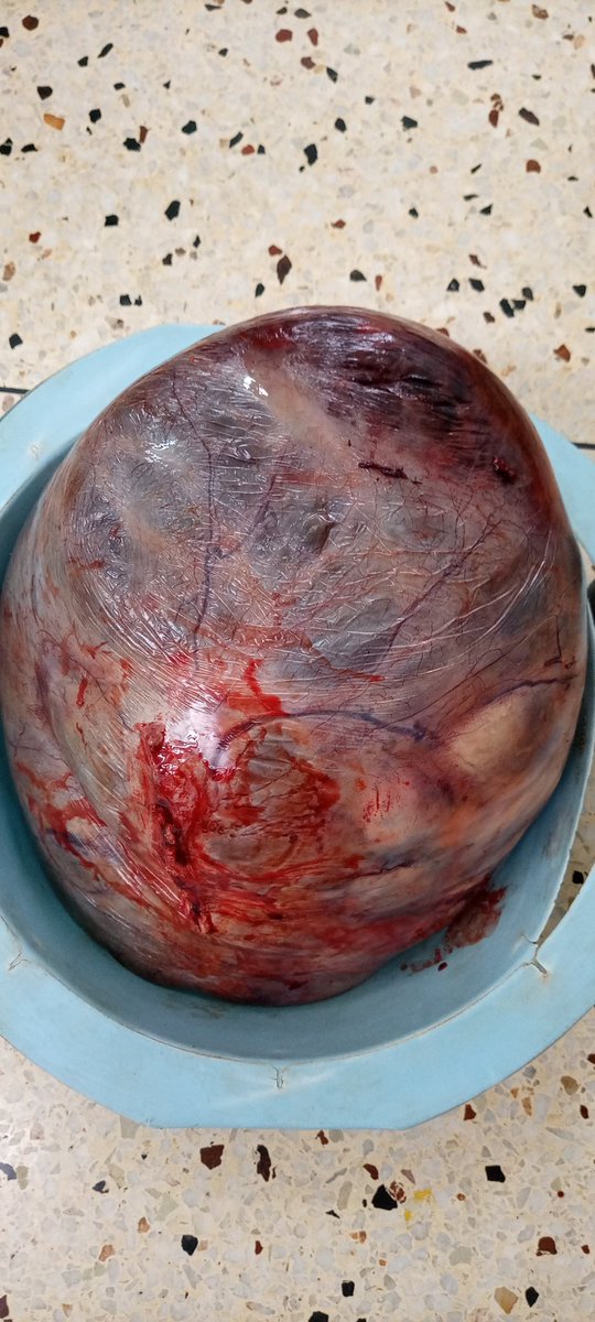 Pregnancy coexisting with a giant dermoid cyst! 
Cyst removed and pregnancy continued to term!