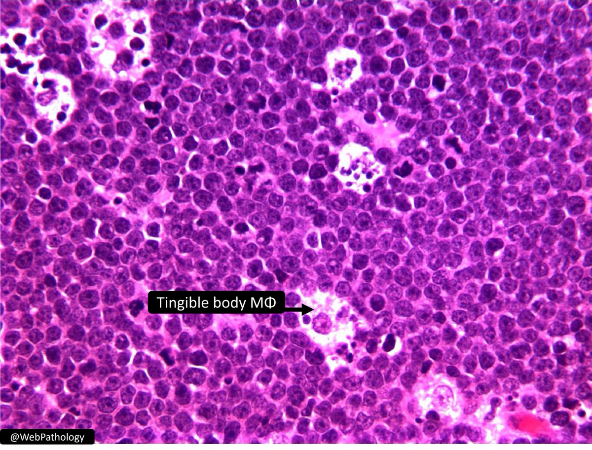 ✅Tingible body MΦ
✅Mitoses
✅“Starry Sky” Pattern🌃
✅Gross “fish-flesh' appearance
of lymphoma
→Burkitt Lymphoma of Small Intestine
#GIPath #PediPath #PathTwitter #hemepath #pathology