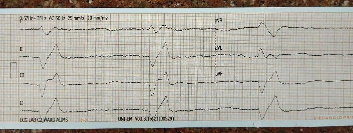 Early morning got a call for this ECG.
They wanted me to put a TPI.
What is happening here?
#CardioTwitter #MedTwitter