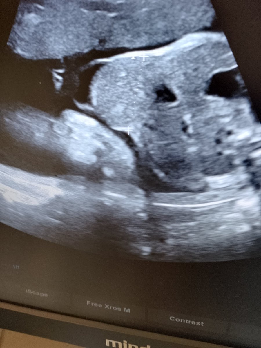 Omphalocele. 2D ultrasound images of at fetus 30 weeks gestational age) revealing  mid-line anterior abdominal wall defect with herniating membrane covered sac containing fluid, and liver #Radiology #MedTwitter #RadTwitter