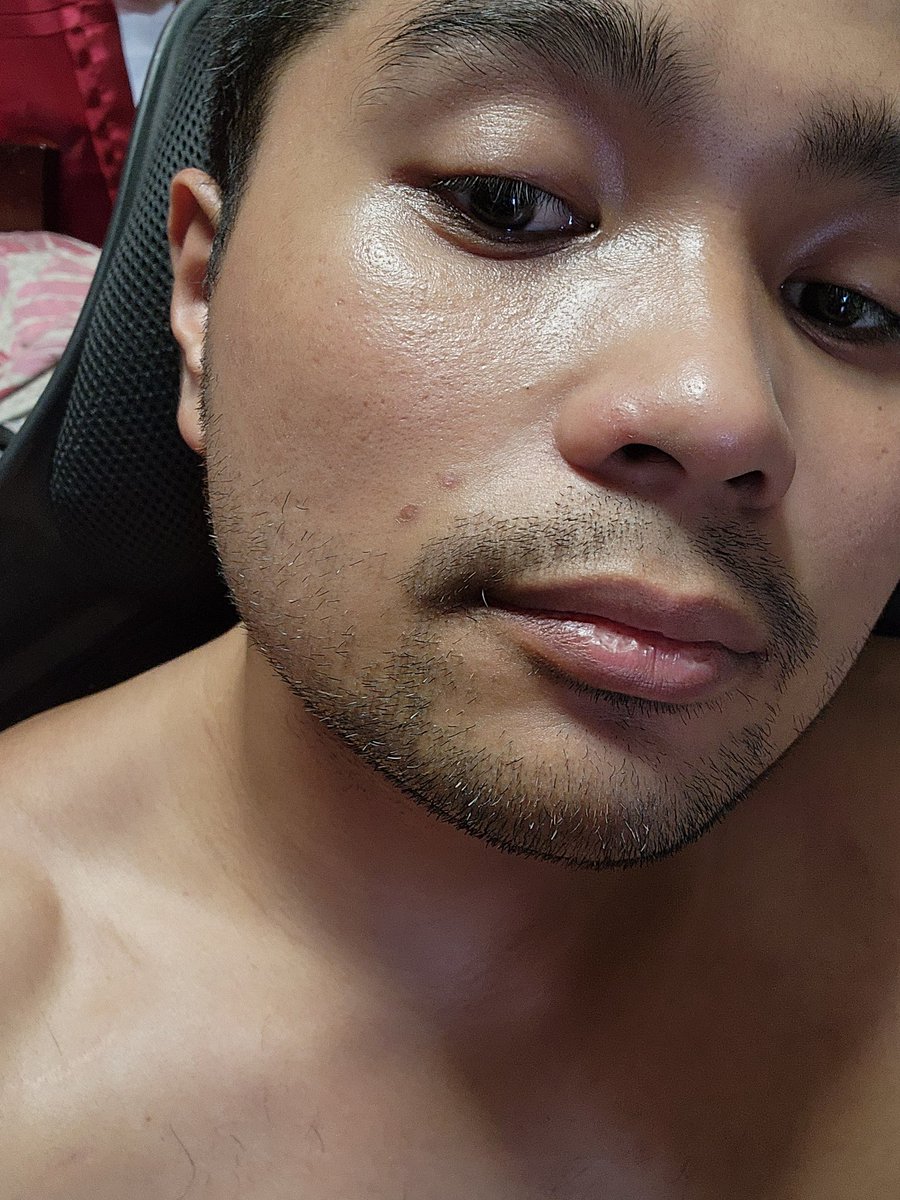 It just amazed me how @SkinHubPH do it. Very visible pa yung scarring ng pimple marks ko kahapon then now pawala na agad.