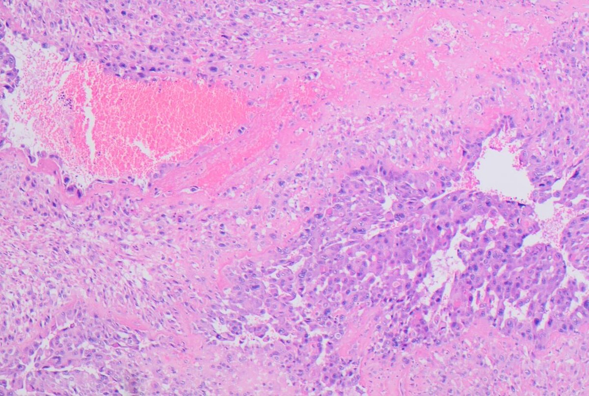 ISGyP 164.1: 34 female: Continued abnormal bleeding 7 months post partum.  Persistent low level BHCG.  Uterine AVM embolization 1 month prior but bleeding continued so had hysterectomy.
Diagnosis: Placental site trophoblastic tumour